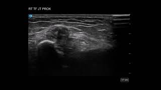 Knee Ultrasound Proximal Tibiofibular Injection [upl. by Veronika937]