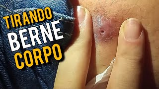 🎯 COMO RETIRAR BERNE NO CORPO HUMANO ❌️ [upl. by Nahsed]