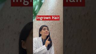 Ingrown Hair Removal  Ingrown Hair  Strawberry Legs shorts [upl. by Olegnad]