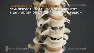 Cervical Hybrid – Cervical Spine Surgery [upl. by Lartnom542]