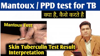 What is Mantoux Test for TB  Procedure and Interpretation Tuberculin Test Result  PPD Test [upl. by Atiuqiram]