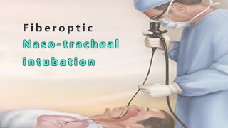 Fiberoptic nasotracheal intubation [upl. by Diane]