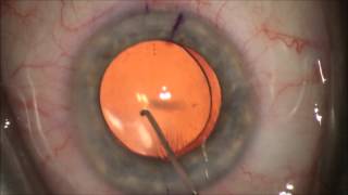 Correction of Astigmatism with Toric Intraocular Lens during cataract surgery See Better [upl. by Dermot625]