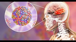 Rare Case of Meningoencephalitis byListeria monocytogenes in a YoungImmunocompetent Adult [upl. by Lane989]