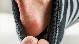 The Basics Should You Pop a Blister [upl. by Abraham]