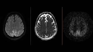 Luxury perfusion of the brain on MRI [upl. by Rosmarin]