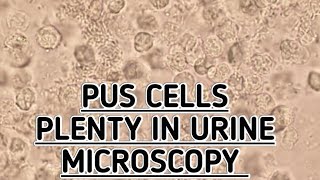 Pus CellsPlenty seen in urine microscopy showing urine tract infectionUTIPyuria seen in urine [upl. by Tony587]