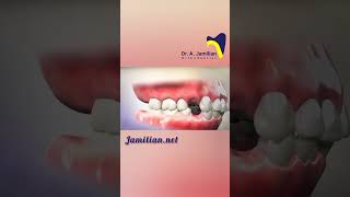 Orthodontic First Premolar Extractiondentist orthodontics orthodontistextractionPremolarspace [upl. by Aihtela5]