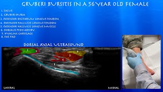 Ultrasound of a Gruberi Bursitis in a 56 Year Old Female by probeultrasound [upl. by Winton]