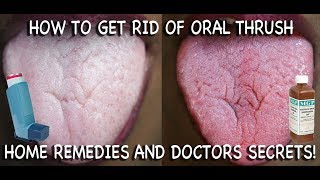 How to Treat Candida at Home Doctors Advice [upl. by Keriann362]