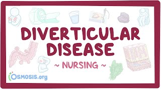 Diverticular disease Clinical Nursing Care [upl. by Irfan894]