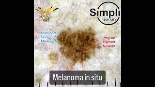 Melanoma in situ [upl. by Misty625]