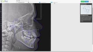 CefMed cefalometría  Cómo crear cefalogramas [upl. by Marchal]