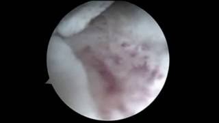 Bankart Repair Revision and Remplisage Surgery for Engaged HillSachs lesion [upl. by Melise563]