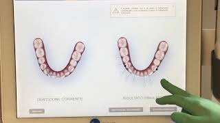 Scanner Intraorale Itero INVISALIGN [upl. by Katherina]