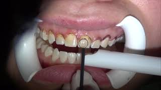 Gingivectomy in aesthetic zone Gummy smile treatment Cosmetic Dentistry Los Angeles 8187760055 [upl. by Ludmilla]