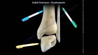 Ankle Fractures and the Syndesmosis  Everything You Need To Know  Dr Nabil Ebraheim [upl. by Ahcmis261]