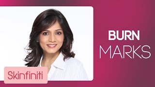 How To Treat Burn Marks  Skincare  Skinfiniti With DrJaishree Sharad [upl. by Urd]