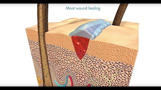 Flamigel  Optimal moist wound healing with Flamigel [upl. by Notniuq173]