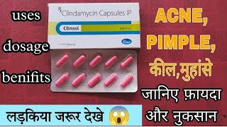 clinsol capsule uses in hindi  clindamycin capsule uses  कील मुहांसे दाने  Acne pimple treatment [upl. by Blumenthal]