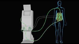 HIPEC Heated Intraperitoneal Chemotherapy [upl. by Ardnasirk]