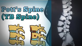 Spinal Tuberculosis Symptoms Diagnosis and Treatment Explained in Hindi amp English tbspine [upl. by Intyrb15]