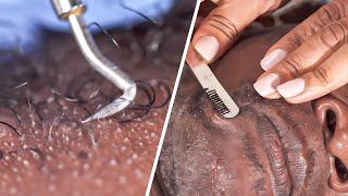 Ingrown Hair Treatment [upl. by Fendig]