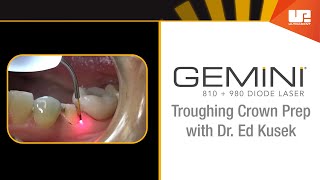 Troughing Crown Prep  How To Use the Gemini™ Laser [upl. by Lacefield]