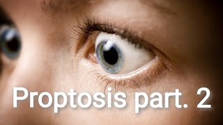 Orbit  Proptosis Diagnosis and Treatment Part 3 [upl. by Hertz]