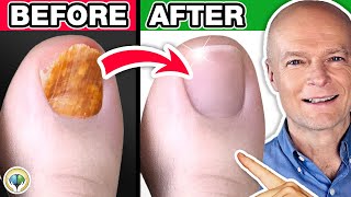 1 Absolute Best Toenail Fungus Cure [upl. by Arreip]