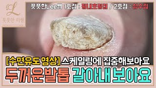 수면 유도 영상 두꺼워진발톱 갈아내볼게요 스케일링에 집중해보아요 tinea unguium  Fresh Foot 풋풋한리쌤 성수점  평내호평점  동탄역점 [upl. by Neeluj601]