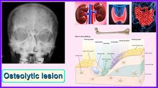 osteolytic lesion [upl. by Hepsibah]