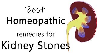 Best homeopathic medicine for stone in kidney  Dr Sanjay Panicker [upl. by Stepha]