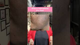 How does chemical peel help chemicalpeeling pigmentation skincare skincaretips [upl. by Idnyl]