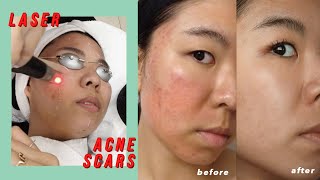 Picosure Laser for Acne Scars amp Hyperpigmentation Before amp After [upl. by Anaitak]