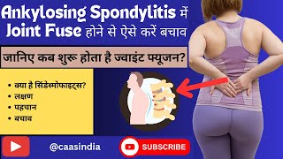 How to prevent joint fusion in Ankylosing Spondylitis in Hindi [upl. by Noizneb719]