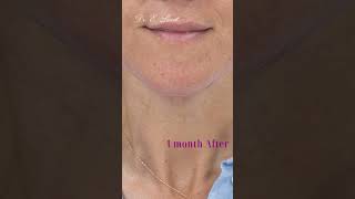 Neck lift Before amp After [upl. by Walsh]