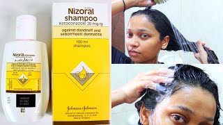 How to use Nizoral shampoo for effective results [upl. by Trudnak90]