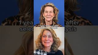 1 year follow up after selective neurolysis facialparalysis synkinesis acousticneuroma [upl. by Lody]