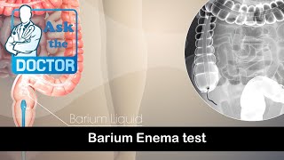 Barium Enema [upl. by Scoter]