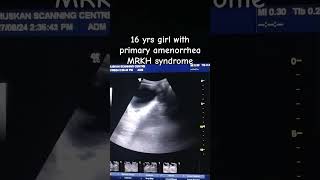 uterineagenesis MRKHsynrome primaryamenorrhea ultrasoundscans menarche [upl. by Ful203]