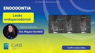 Lesão periodontal  Caso Clínico com a Dra Mayara Viandelli [upl. by Dnartreb]