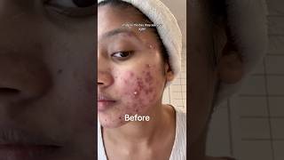 Day 75 without accutane✌️🤞 Haven’t got any active breakouts🙏 acneskin acnejourney accutane [upl. by Aicnorev]