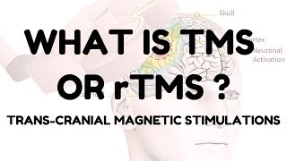 rTMS  Repeated Transcranial Magnetic Stimulation [upl. by Dorette]