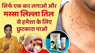 बिना दर्द गारंटी के साथ मस्सा निकालने की बेस्ट दवा  Best Mole Removal Cream  Umang Mole Removal [upl. by Thorne766]