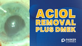 ACIOL Removal Plus DMEK [upl. by Pavkovic]