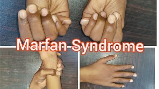 Marfan Syndrome  Clinical Signs [upl. by Hannad]