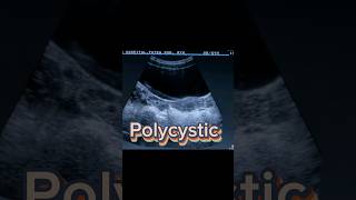 Follicular Ovary  Polycystic Ovaries  PCOS  PCOD  Dominant Follicle on Ultrasound [upl. by Adnerb329]