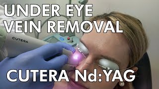 Under Eye Vein Removal Cutera NdYAG Laser  Dr Paul Ruff  West End Plastic Surgery [upl. by Meryl118]