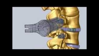 Minimally Invasive Transforaminal Lumbar Interbody Fusion Procedure [upl. by Maurice]